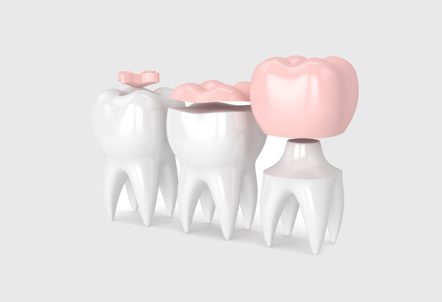 What Are the Advantages of Porcelain Inlays and Onlays?